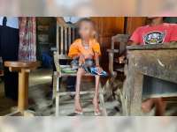 Idap Penyakit Komplikasi, Bocah 9 Tahun di Blora Ini Alami Gagal Tumbuh