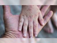 Waspada Penularan Campak pada Anak, Tenaga Medis Ingatkan Risiko Komplikasi Hingga Peradangan Otak